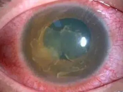 红眼病症状图片