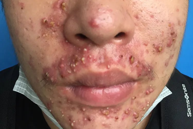 闭口痘痘长什么样子