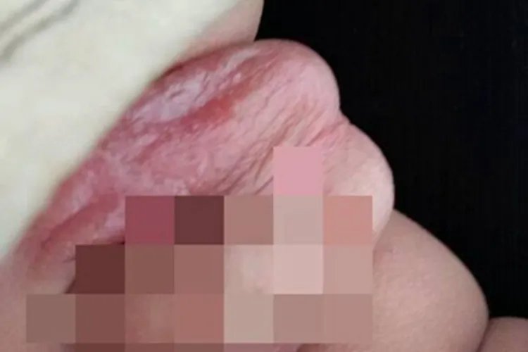 阴囊湿疹症状图片