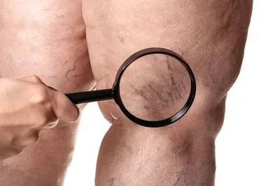 怎么预防下肢深静脉血栓