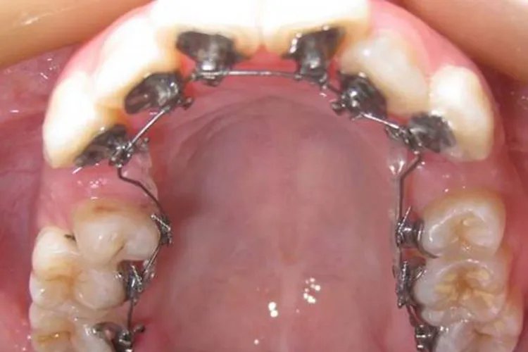 大牙牙套的图片