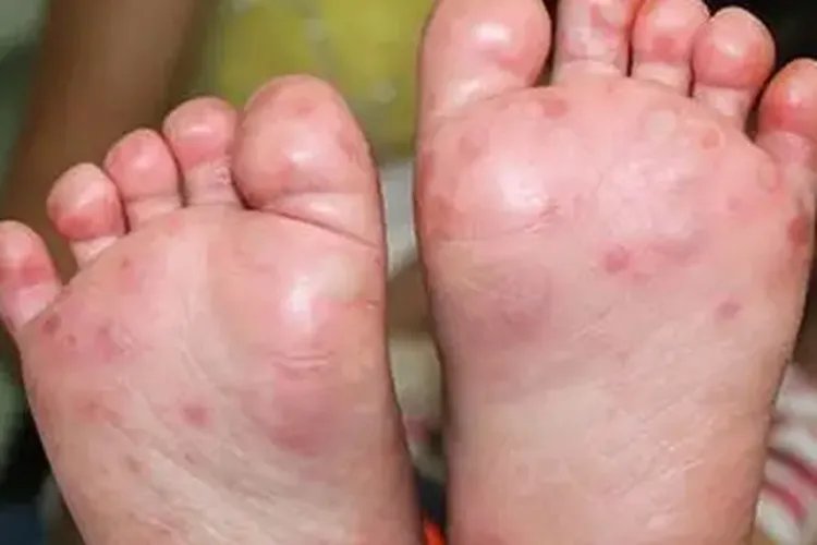 手足口病的特征图片