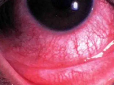 红眼病症状图片
