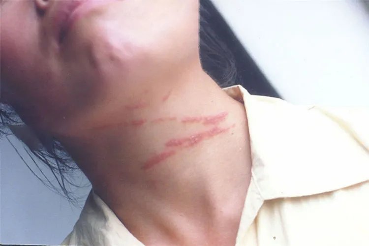 被隐翅虫咬的照片