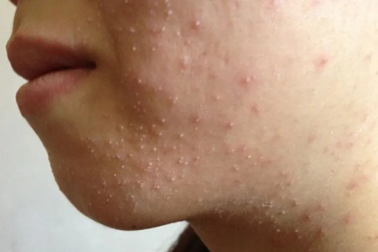 脸上长痘痘位置图解