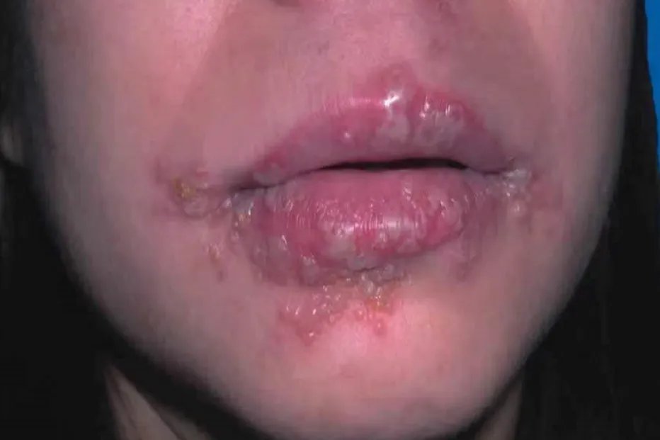 单纯疱疹图片部位