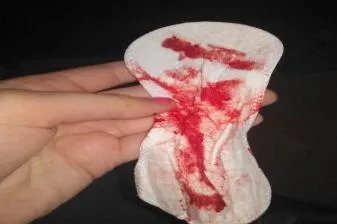 宫颈癌早期症状图片