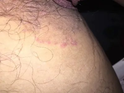 湿疹大腿症状图片