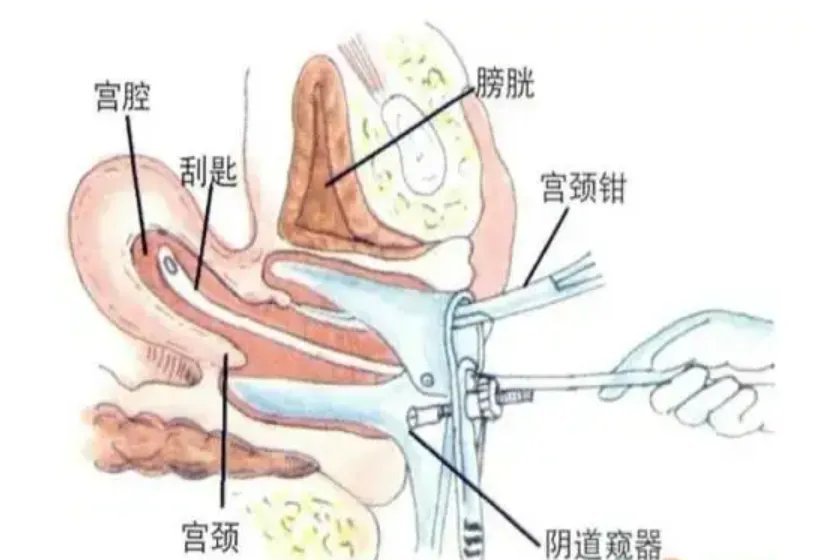 刮宫图片实物图