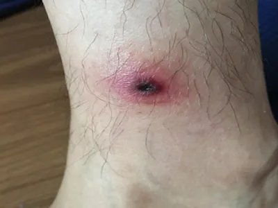 恙虫病焦痂图片