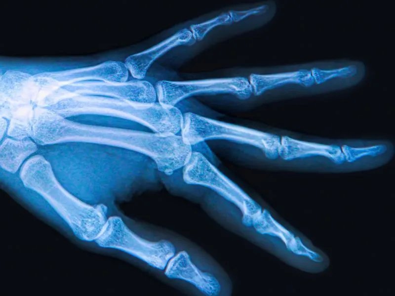 手指再造术的效果