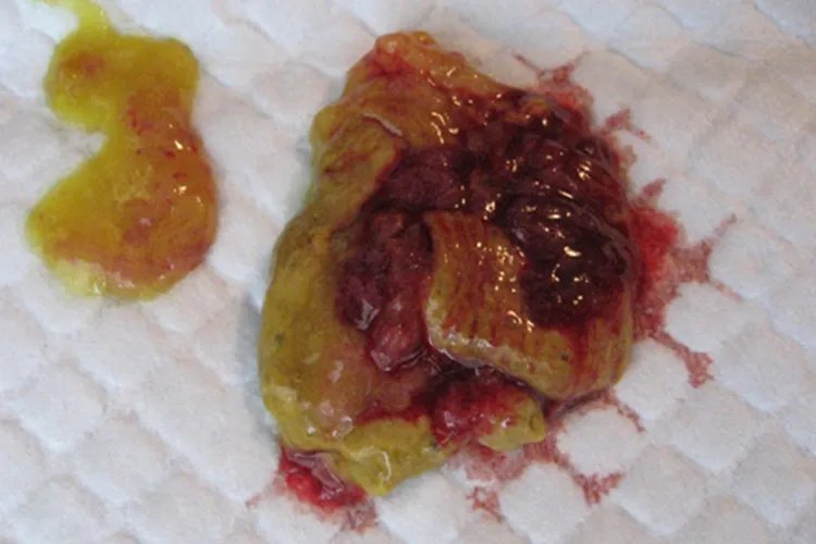 直肠癌大便图片