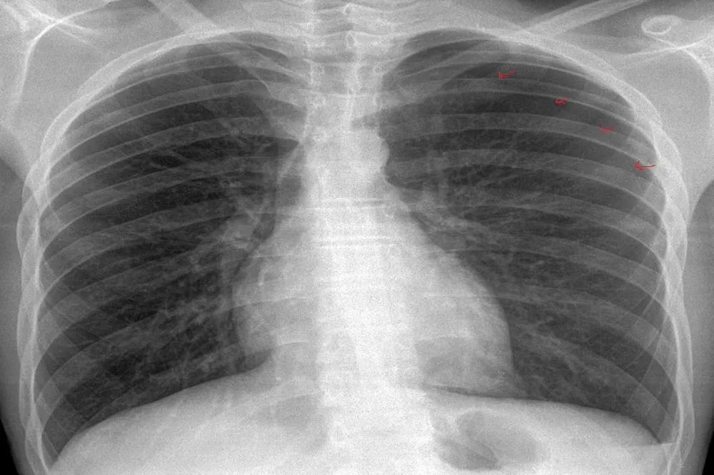 正常人的胸片图片