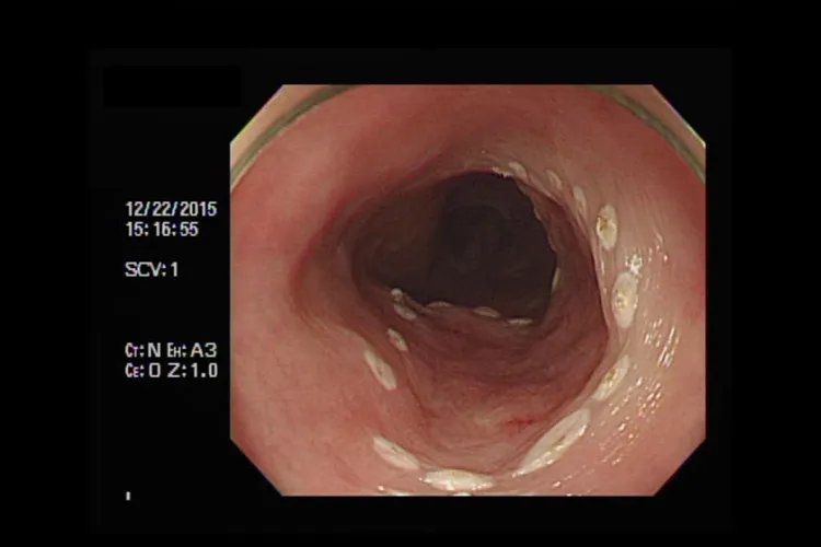 食道癌的早期症状表现