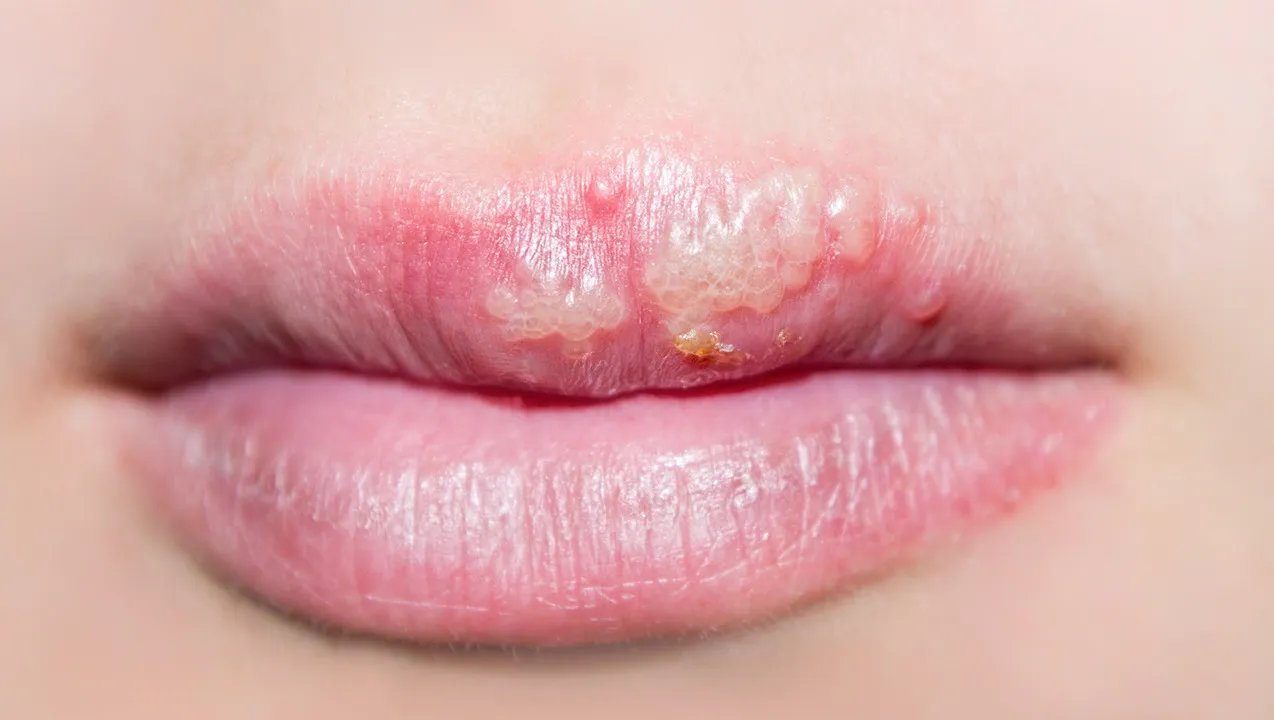 上火了嘴巴起泡怎么办