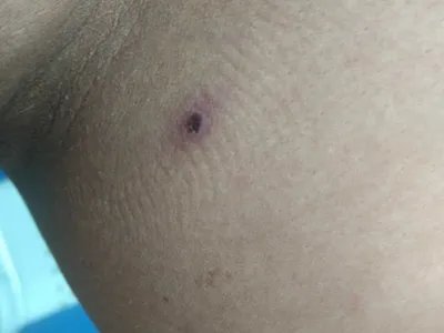 恙虫病焦痂图片