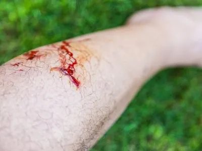 被老鼠咬了怎么办