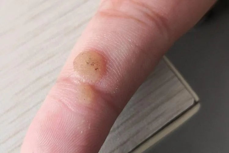 什么是寻常疣图片大全