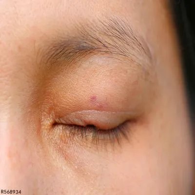 眼皮肿是什么原因引起 眼皮肿的常见原因分析