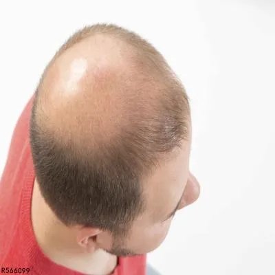 爸爸秃头会遗传给女儿吗