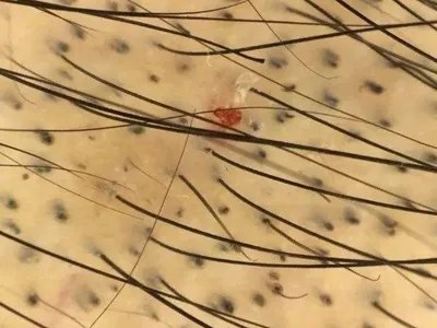 拔毛癖头皮症状图片