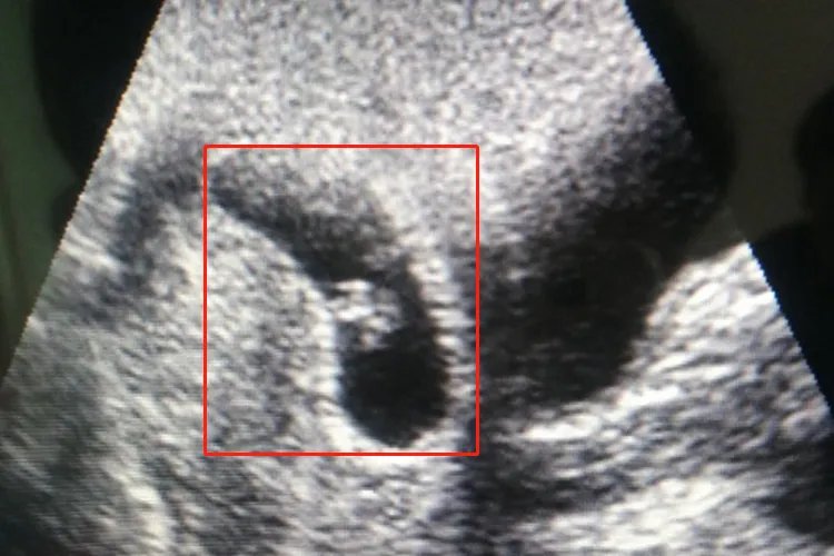 刚怀孕胎儿是什么形状图片