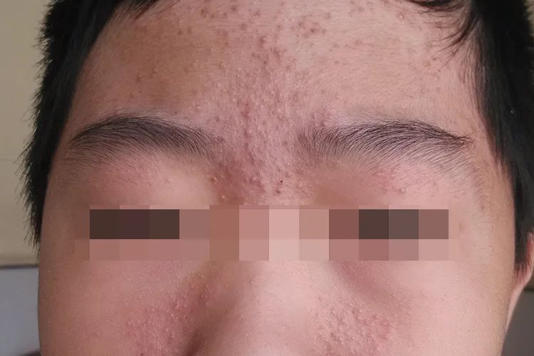 闭口痘痘长什么样子