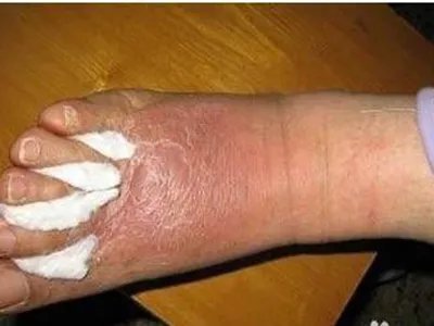 急性网状淋巴管炎脚背症状图片