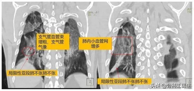 为什么湖北新增病例突增14840例？临床诊断病例是什么？