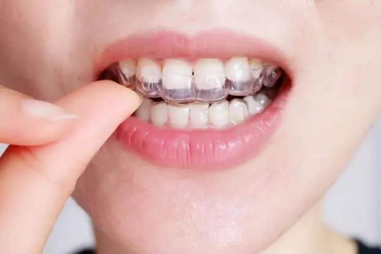 大牙牙套的图片