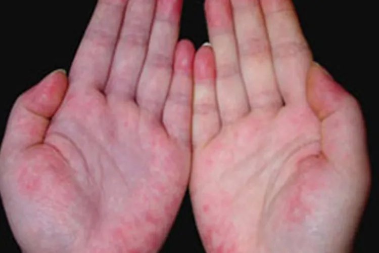 红斑狼疮是什么症状图