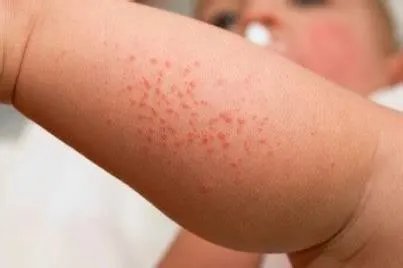 宝宝幼儿急疹初期图片