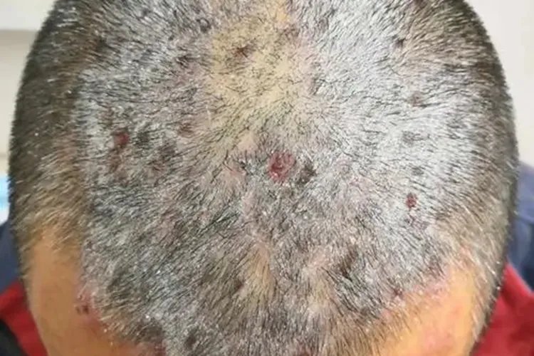 大块头皮屑图片