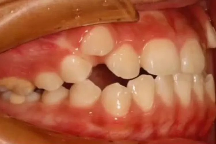 虎牙长在牙龈上方图片
