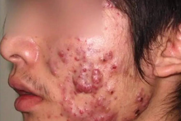 脸上长痘痘位置图解