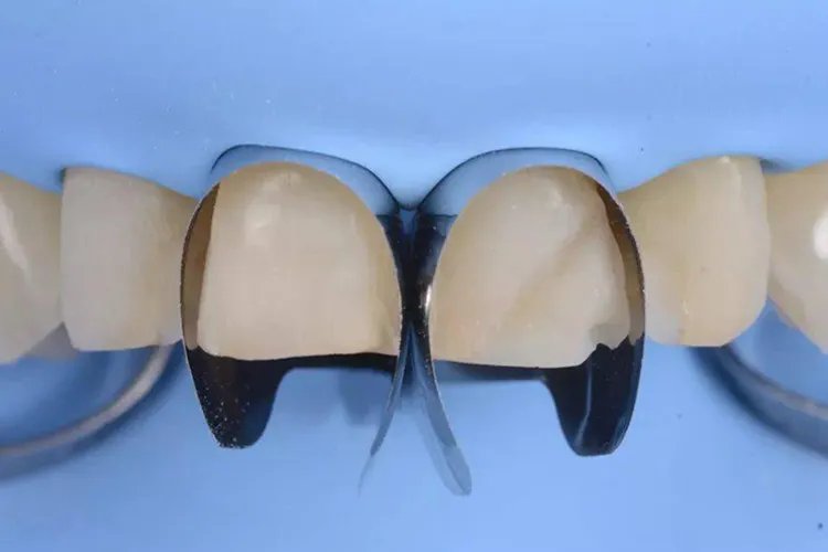 门牙补牙过程图解