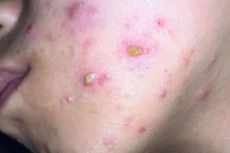 痤疮是什么图片