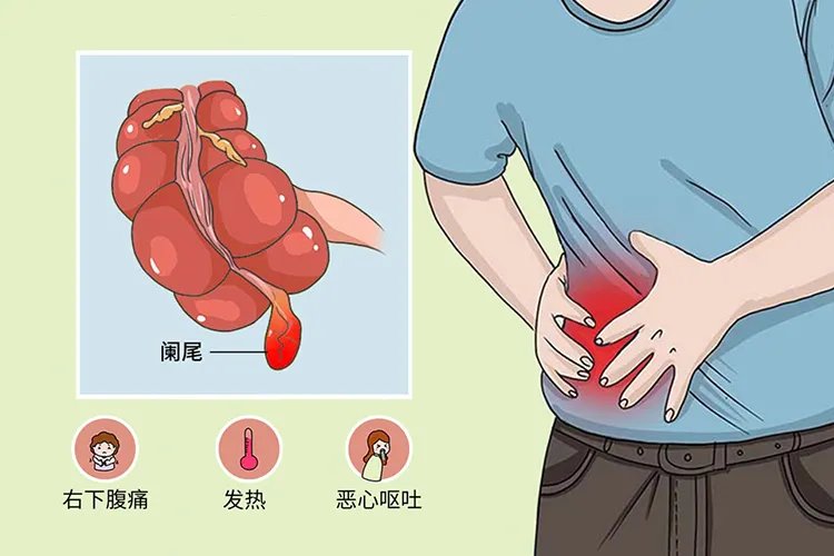 阑尾炎疼在腹部哪个位置