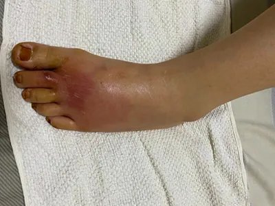 急性网状淋巴管炎脚背症状图片
