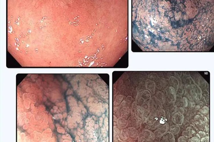 食道癌的早期症状表现