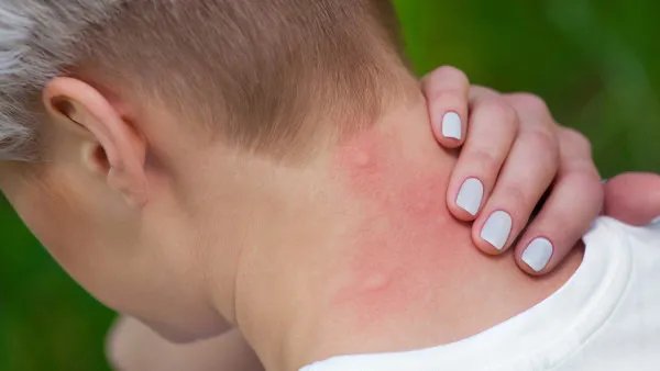 痱子与湿疹有何不同