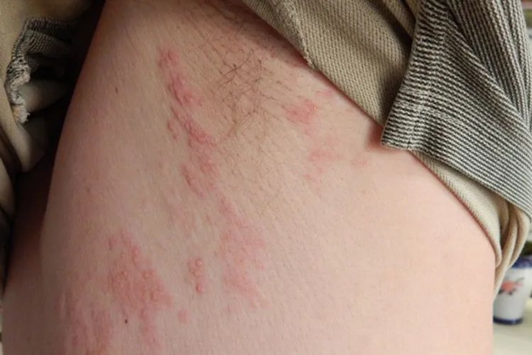 腋下蛇盘疮图片