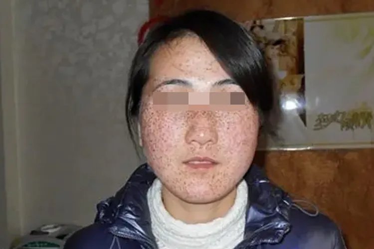 雀斑的图片是什么样子
