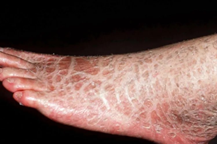 鱼鳞病症状图片