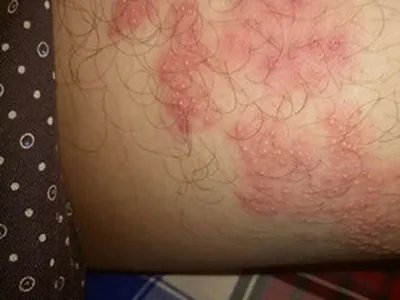 湿疹大腿症状图片