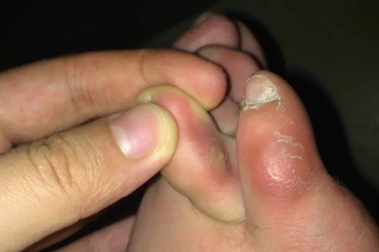 鸡眼图片大全大图