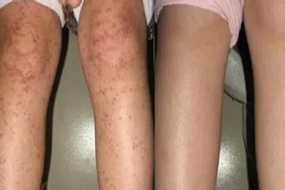 小孩膝盖上有紫癜图片