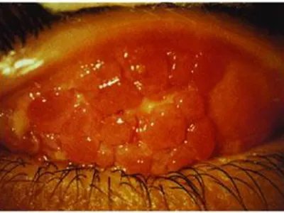 红眼病症状图片