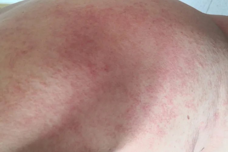 热痱子是什么样图片