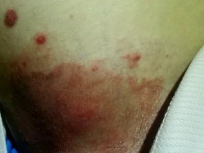 湿疹大腿症状图片